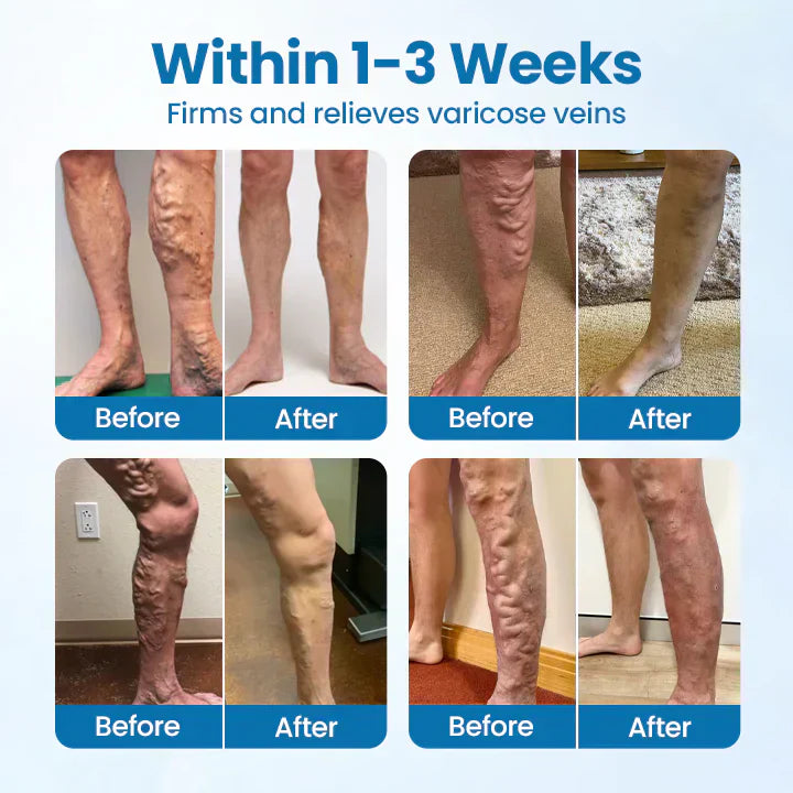 AQA® VeinGuard Herbal Spray-✅ Clinically proven to eliminate varicose veins in just 7 days!