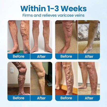 AQA® VeinGuard Herbal Spray-✅ Clinically proven to eliminate varicose veins in just 7 days!